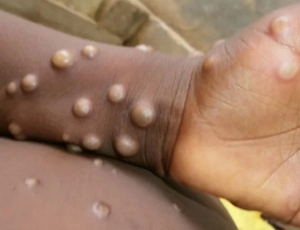 El lanzamiento inicial de la vacuna contra la viruela del mono en Israel se centrará en los hombres seropositivos y en riesgo